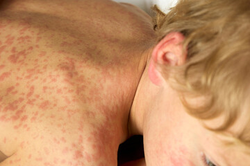 Naklejka premium Close-up of the boy's back, covered with red itchy spots from an unpleasant illness. Severe allergies appeared on the child's body from medications