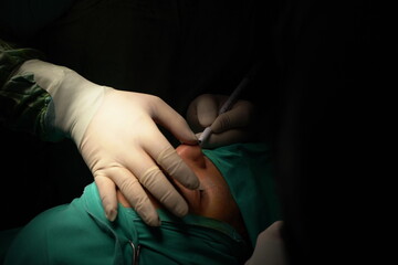 Doctor performing nose surgery in the operating room.  green dresses and black room in the operating room
