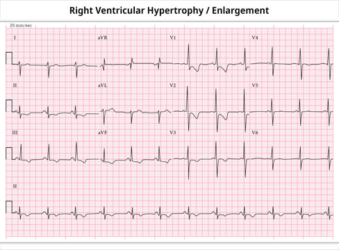 ECG Right Ventricular Enlargement - ECG Paper 12 Leads - Right Ventricular Hypertrophy