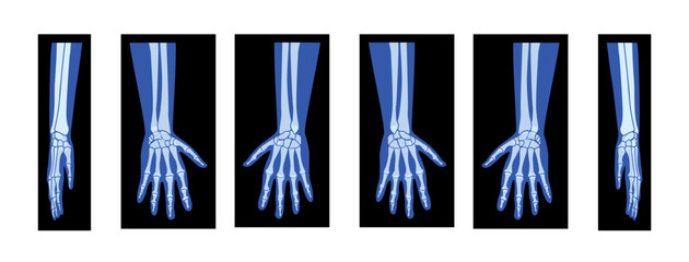 Set of X-Ray Hands with Radius, Ulna Skeleton Human body, Bones adult people roentgen front back side view. 3D realistic flat blue color concept Vector illustration of medical anatomy isolated