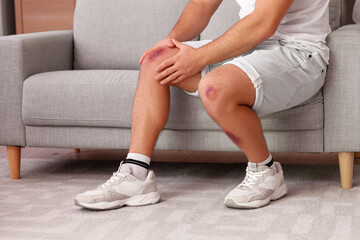 Man with bruises on his legs sitting on sofa at home