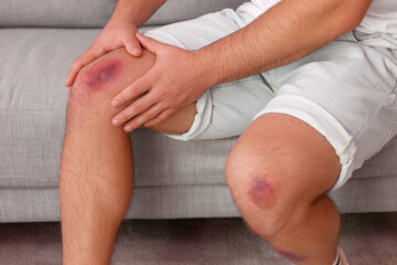 Man with bruises on his legs sitting on sofa at home