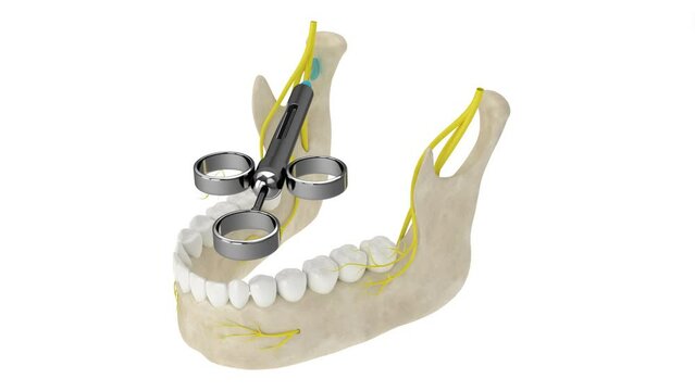 Mandibular arch with gow-gates nerve block. Types of dental anesthesia concept. 