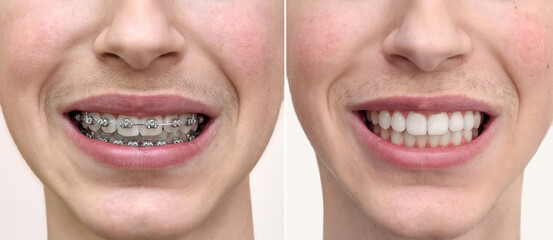 Teeth of a teenage boy before and after dental braces treatment. Close-up. Health care and medical...