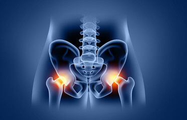 Hip pain, hip osteoarthritis, x-ray view, conditions, causes and treatment. 3d illustration