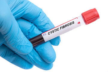 Obraz premium Cystic Fibrosis. Cystic Fibrosis disease blood test in doctor hand