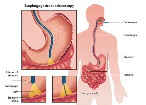 Medical illustration of an Esophagogastroduodenoscopy with two details showing the procedure and instruments used, with annotations.