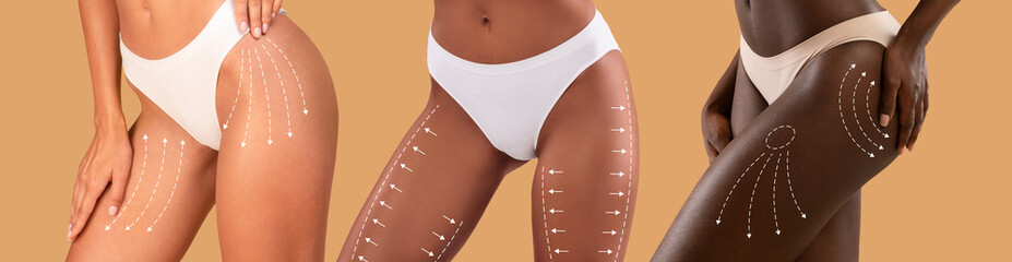 Young different ladies in bikini with slim body with lines for figure shaping, plastic surgery