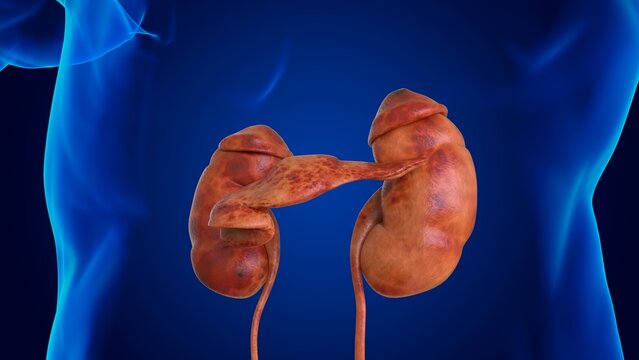 human damaged kidney anatomy for medical concept 3D
