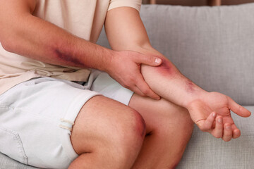 Man with bruises on his body at home