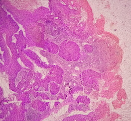 Photomicrograph showing tongue squamous cell carcinoma Grade II. Oral Invasive SCC.