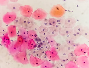 Paps smear under microscopy showing inflammatory smear with hpv related changes. Cervical cancer....