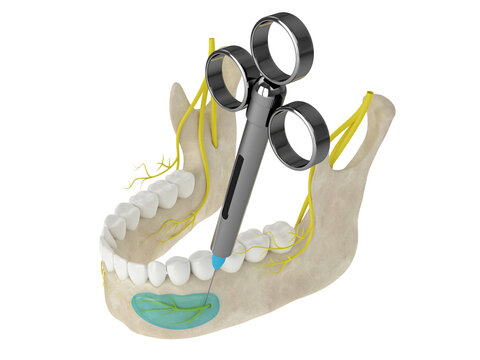 Mandibular arch with incisive nerve block