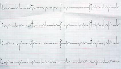ECG ElectroCardioGraph paper that shows Normal Sinus Rhythm NSR with frequent PACs Premature Atrial...
