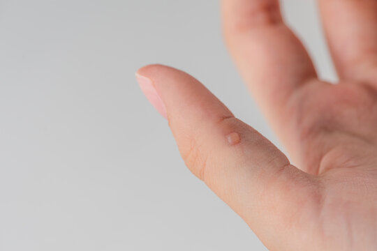 Wart on hand. The concept of treating warts and other skin defects. Close-up of a wart on a finger, a benign growth on human skin.