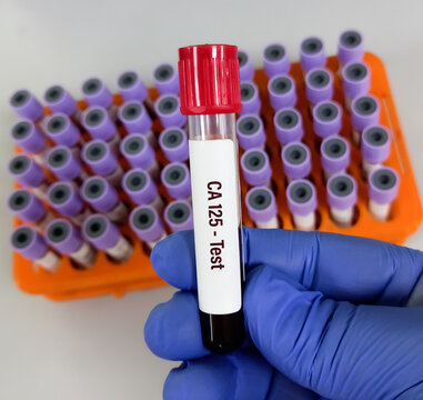 Test Tube with blood sample for CA 125 test. Tumor Marker for ovarian cancer. A medical testing concept in the laboratory background.