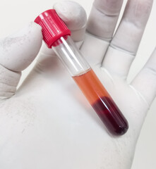 Hemolysis (abnormal) human or plasma in test tube on white background. Hemolysis sample can cause...