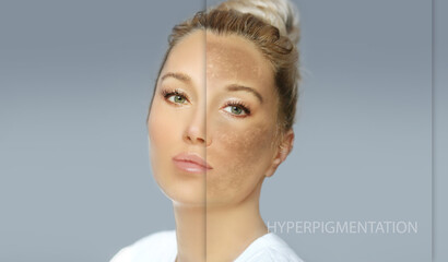 Dark spots, freckles,hyperpigmentation(melasma or chloasma),concept - skin lightening, skin...