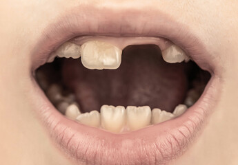 Fototapeta premium Close up of unhealthy baby teeths. Kid patient open mouth showing cavities teeth decay