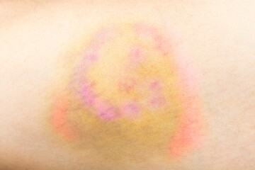 Fototapeta premium Closeup on a Bruise on wounded arm skin. Gender violence concept