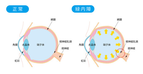 正常な目と緑内障の目の断面
