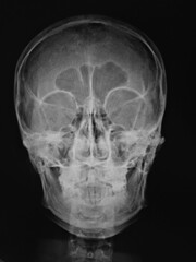 x ray of human skull AP
