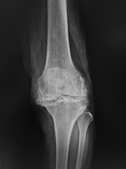 Osteoarthritis both knee . film x-ray AP