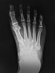 film X-ray show bone of human's foot