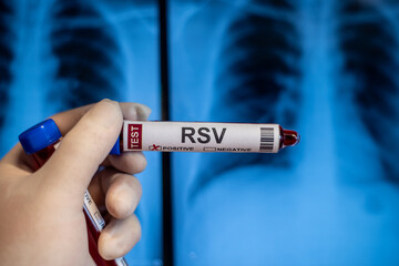 Obraz premium Blood collection tubes Respiratory syncytial virus(RSV) test positive results,medical concept
