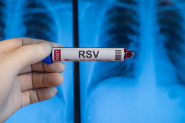 Blood collection tubes Respiratory syncytial virus(RSV) test positive results,medical concept