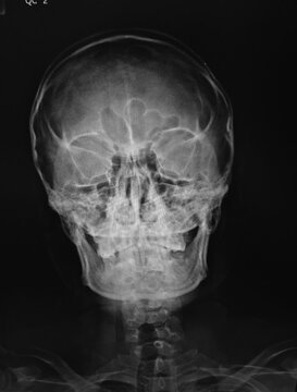 x ray image of  skull AP