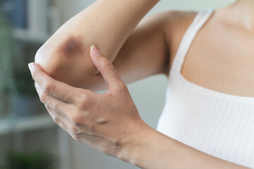 woman get injured and have bruised on her arm.