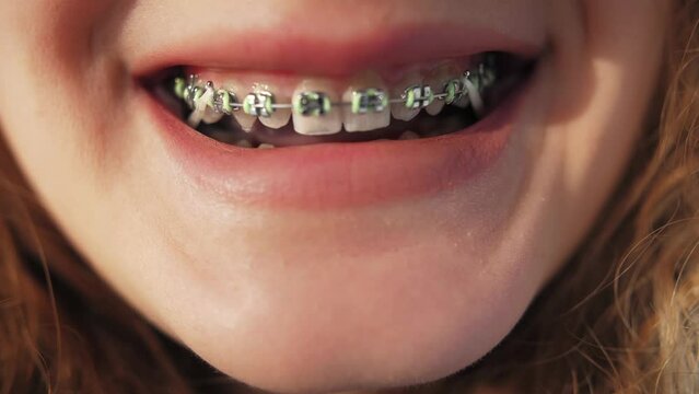 Woman smiling with a braces system.Stomatology teeth dental close-up.Orthodontic routine.