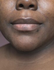 Fototapeta premium Brown skin with dark spots, hyperpigmentation on brown skin, african american woman with skin blemishes, imperfect skin