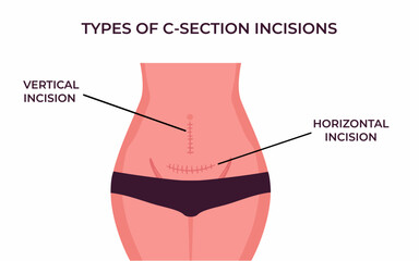 Type of Sutures after cesarean section vertical and horizontal cesarean scar.