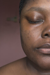 Brown skin with dark spots, hyperpigmentation on brown skin, african american woman with skin...