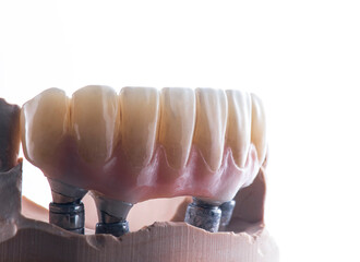 hybrid ceramic bridge on implants