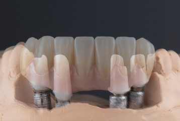 Fototapeta na wymiar hybrid ceramic bridge on implants