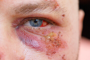 Purple hematoma under the eye of a man damaged with blood