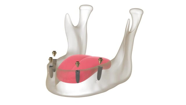 Bar retained removable overdenture installation supported by implants