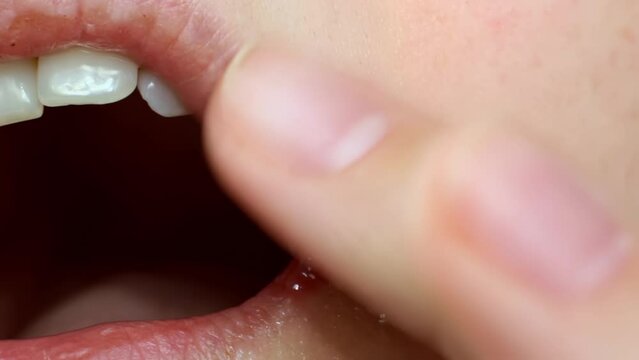 Woman hands applying a medical ointment on a lip skin with Herpes Labialis virus close up