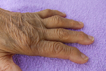 Fototapeta premium hand with arthritis on a purple background. inflammation hand in the elderly