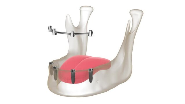 Removable overdenture installation on bar clip attachment, supported by implants