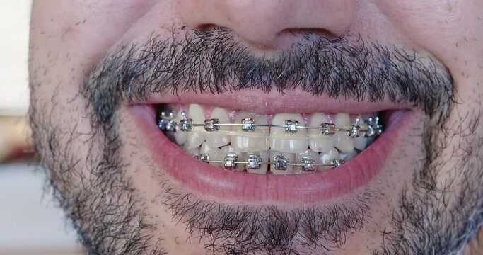 Close-up of a metal bracket system on white, even teeth. Braces for bearded man