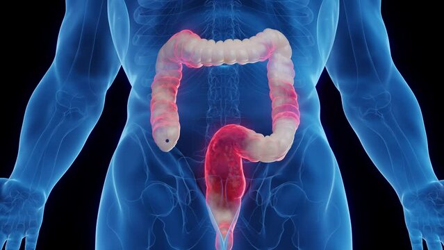 3D medical animation of a man's inflamed colon