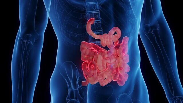 3D medical animation of a man's inflamed small intestine