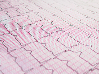 Electrocardiogram example of a normal 12-lead sinus rhythm, close up