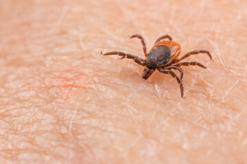 Dangerous parasitic castor bean tick at biting to a human skin. Ixodes ricinus or scapularis. Closeup of insect mite on pink epidermis. Danger of tick-borne diseases transmission by infected parasite.