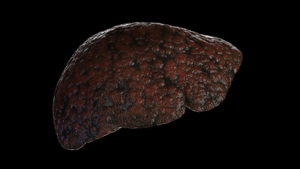Fototapeta premium 3D medical illustration of a cirrhotic liver