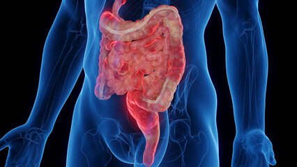 3D medical illustration of a man's intestines affected by Crohn's disease